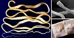 come capire che i vermi nel corpo