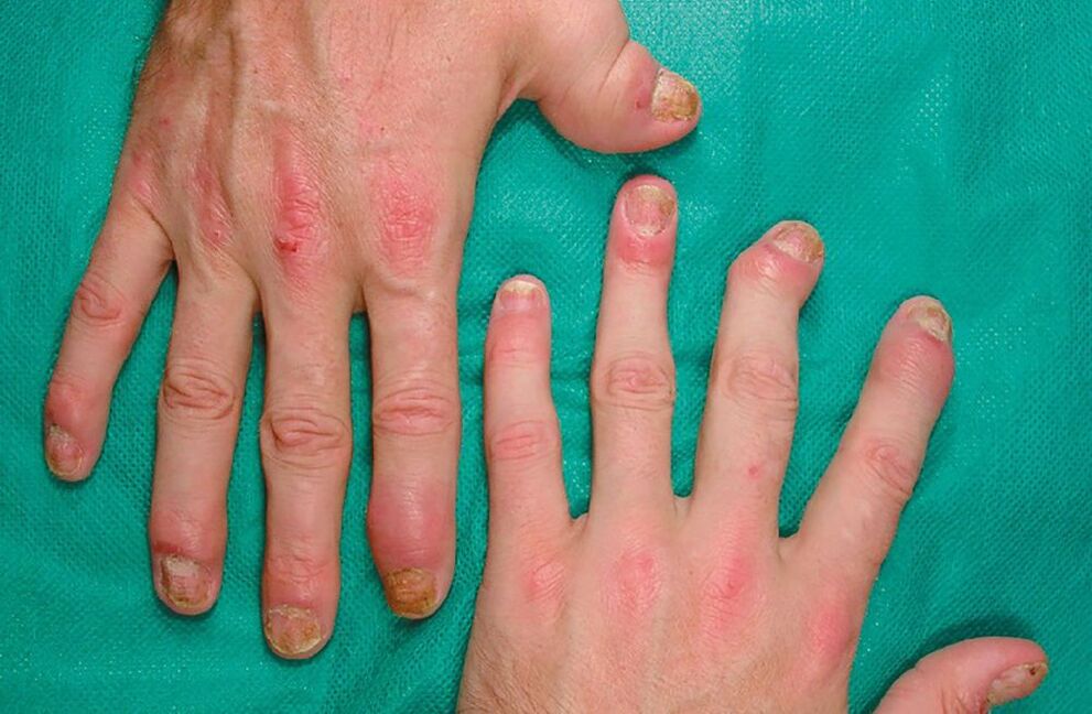 allergia con parassiti nel corpo
